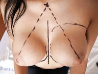 Aletta Ocean goes through successful plastic surgery operation